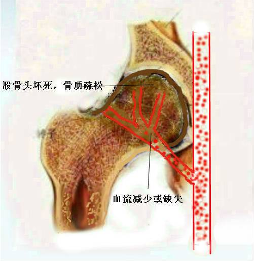 如何确诊股男科缺血性坏死? 